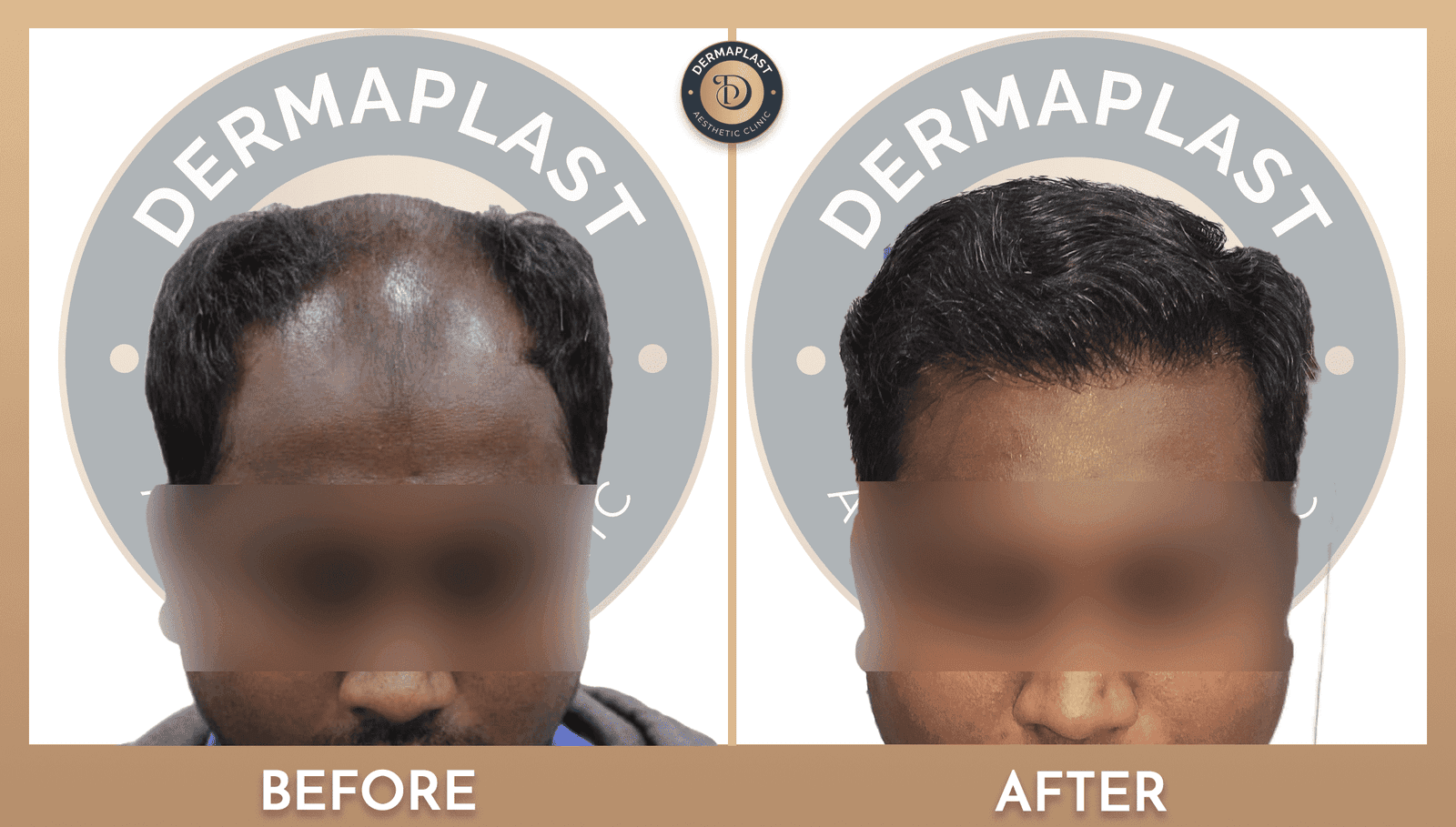 Before hair transplant: Dermaplast patient, front and top